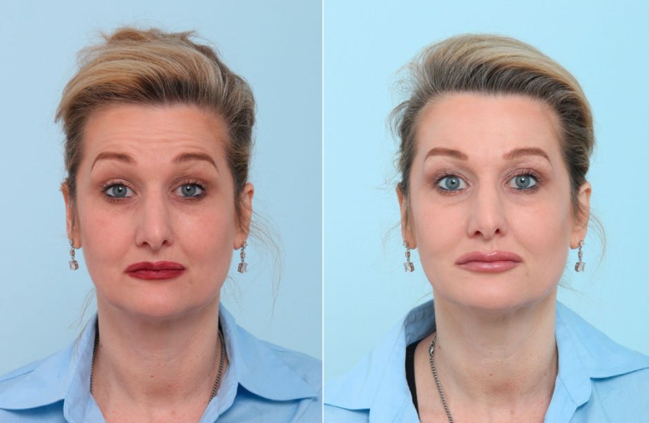 Botox Results: Before & After Transformation