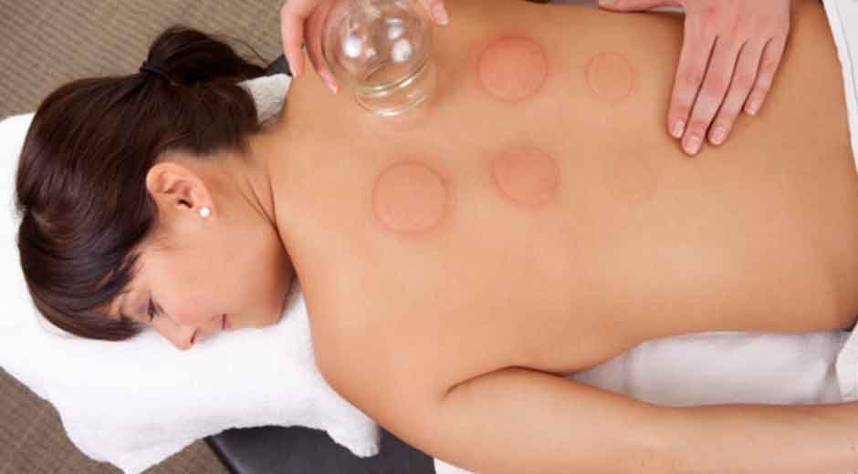 What is Cupping Therapy? Is It Relevant Today
