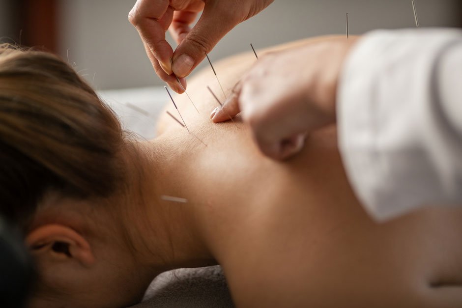 Acupuncture and the Modern Mind