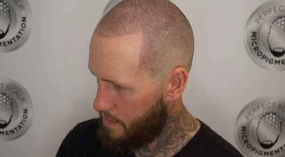 How Aftercare Contributes To Longevity and Quality After a Scalp Tattoo