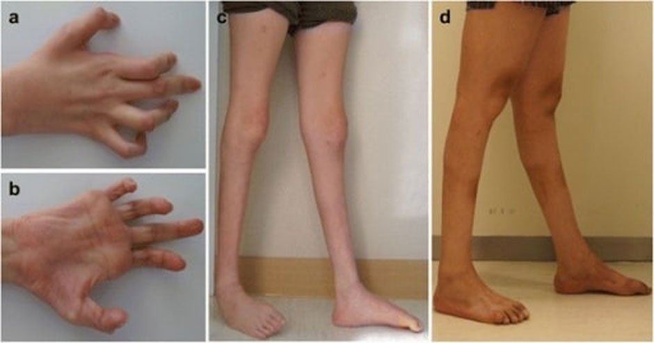 Living with Charcot-Marie-Tooth Disease: Understanding the Impact