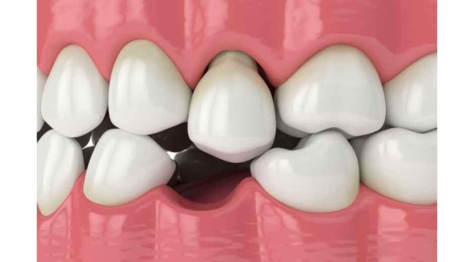 Restoring Confidence: Options for Damaged or Missing Teeth