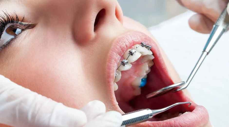 What's the ideal age for metal braces according to experts in Surrey?