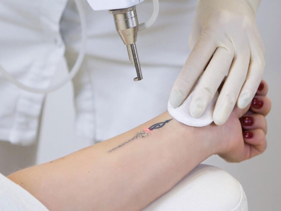 Your Tattoo Removal Journey: Step by Step