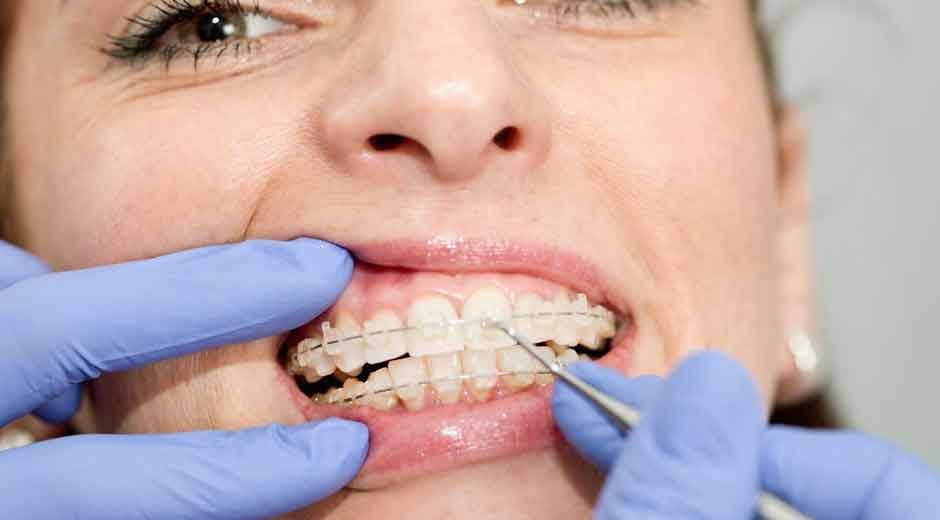 What to Expect at Your Braces Adjustment Appointment in Brookhaven