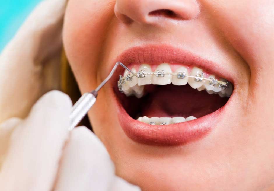 Discover the Benefits of Ceramic Braces for Your Smile