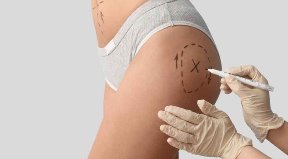 Butt Fillers Near Me: A Non Surgical BBL Alternative for Natural Bum Enhancement