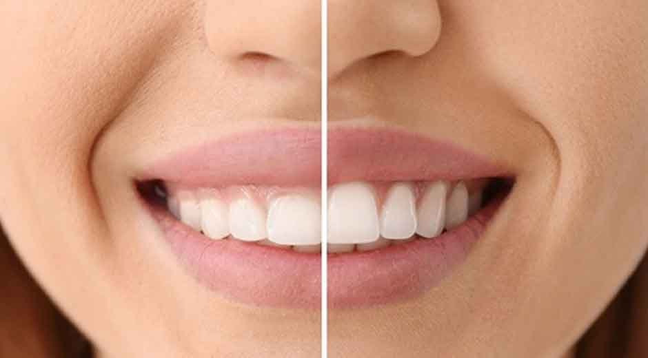 Gum-Contouring-How-It-Transforms-Your-Smile