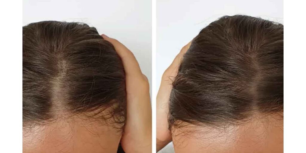 Subtle Signs of Early Hair Loss and How to Respond Gracefully