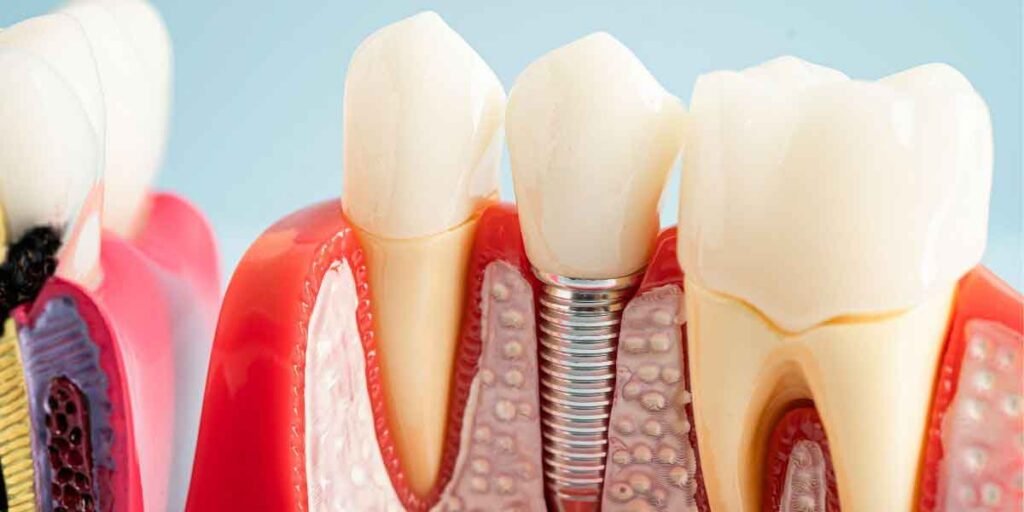 Why Dental Implants Feel More Natural Than Any Other Tooth Replacement