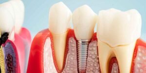 Why Dental Implants Feel More Natural Than Any Other Tooth Replacement